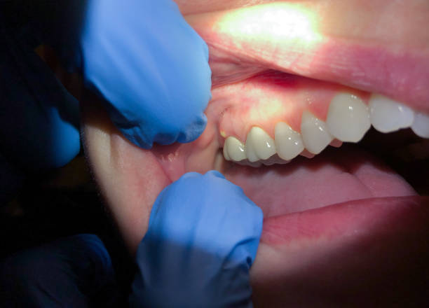 Best Root Canal Emergency Dentist  in Bellefontaine Neighbors, MO